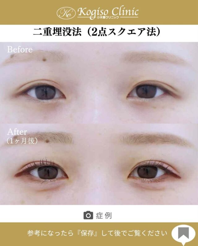✨お目元のご手術がお得に受けられるキャンペーン中✨
9月末まで！！是非この機会に挑戦してみませんか💖
詳しくは公式LINEのキャンペーンをご覧ください😊

2点スクエアー法（二重埋没）

🩺施術内容
上瞼に開けた小さな穴から細い埋没糸を瞼板と皮膚に
スクエアーにかけて二重のラインを形成します。
腫れがとても少なく自然な二重が可能です。

💰施術費用
2点スクエアー法保証付(二重埋没法) ¥70,000 税抜
2点スクエアー法保証無（二重埋没法）¥50,000 税抜
局所麻酔代、お薬代、検診代込み
保証付は術後１年以内に限りラインが消失してしまった場合左右1回ずつ無料で再手術が受けられます。

🔹術後の経過など
腫れ•違和感→2〜3日をピークに1週間程
内出血→稀に出る場合がございますが1週間程で消失

#二重 #二重埋没 #二重埋没法 #埋没法 #二重整形 
#目の整形 #美容整形前後 #美容外科 #美容整形 
#小木曽クリニック