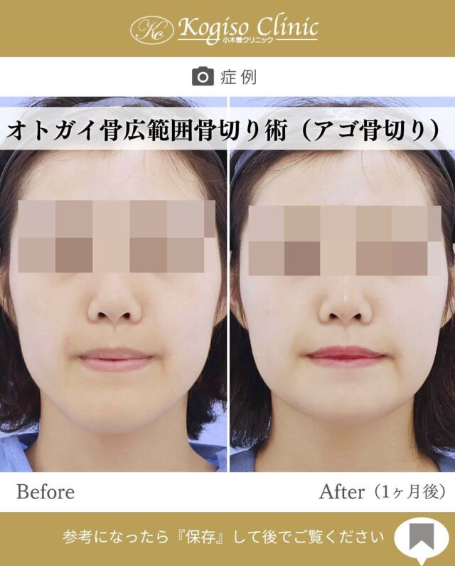 オトガイ広範囲骨切り術

顎が短くなり面長感が解消されました✨
術後1ヶ月でほぼ違和感がないくらいに落ち着きます💭
当院の術式では切除量が多いため、一時的に皮膚の余りが生じますが術後6ヶ月を目安に縮んでいき、よりすっきりしていきます☺️

【オトガイ広範囲骨切り術】
🩺施術内容
当院のオトガイ広範囲骨切り術はオトガイ神経を剥離し、
オトガイ部から下顎角直前にわたりスムーズなカーブを
描きながら広範囲に骨切りするため、切除量が多く変化が大きいだけでなく自然な仕上がりです。

💰施術費用
オトガイ広範囲骨切り術 ¥1,500,000〜税抜
修正の場合は上記価格に修正費がプラスとなります。
別途全身麻酔•物品•検査代計 ¥233,090

🔹術後の経過など
腫れ→個人差はありますが1週間をピークに2週間ほどで大きな腫れは徐々に引いていきます
圧迫固定→術後3日間は24時間フェイスバンテージにて圧迫します
痺れ→オトガイ神経を剥離して手術を行うため、術後しばらく口の周りの感覚が鈍くなります。個人差がありますが6ヶ月程で徐々に回復していきます。
検診→翌日、1ヶ月、6ヶ月
翌日検診の際にドレーンチューブを抜去します。

#輪郭形成 #輪郭整形 #骨切り #アゴ整形 #顎 #下顎前突 #輪郭手術 #骨切り手術 #輪郭整形ビフォーアフター #輪郭整形症例写真 #顔面整形#フェイスライン #美容整形前後 #美容整形 #美容外科 #小木曽クリニック