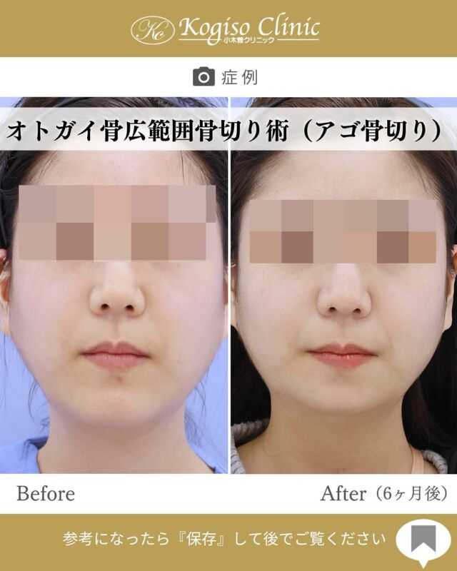 オトガイ広範囲骨切り術

アゴが短くなり、自然な小顔に✨

【オトガイ広範囲骨切り術】
🩺施術内容
当院のオトガイ広範囲骨切り術はオトガイ神経を剥離し、
オトガイ部から下顎角直前にわたりスムーズなカーブを
描きながら広範囲に骨切りするため、切除量が多く変化が大きいだけでなく自然な仕上がりです。

💰施術費用
オトガイ広範囲骨切り術 ¥1,500,000〜税抜
修正の場合は上記価格に修正費がプラスとなります。
別途全身麻酔•物品•検査代計 ¥233,090

🔹術後の経過など
腫れ→個人差はありますが1週間をピークに2週間ほどで大きな腫れは徐々に引いていきます。
圧迫固定→術後3日間は24時間フェイスバンテージにて圧迫します。
痺れ→オトガイ神経を剥離して手術を行うため、術後しばらく口の周りの感覚が鈍くなります。個人差がありますが6ヶ月程で徐々に回復していきます。
検診→翌日、1ヶ月、6ヶ月
翌日検診の際にドレーンチューブを抜去します。

#輪郭形成 #輪郭整形 #骨切り #アゴ整形 #顎 #下顎前突 #輪郭手術 #骨切り手術 #輪郭整形ビフォーアフター #輪郭整形症例写真 #顔面整形#フェイスライン #美容整形前後 #美容整形 #美容外科 #小木曽クリニック