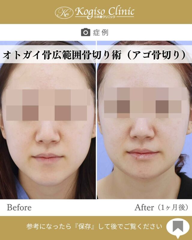 オトガイ広範囲骨切り術

術後1ヶ月でほぼ違和感がないくらいに落ち着きます🧸
当院の術式では切除量が多いため、一時的に皮膚の余りが生じますが術後6ヶ月を目安に徐々に縮んでいき、より骨に馴染んでいきます😌

【オトガイ広範囲骨切り術】
🩺施術内容
当院のオトガイ広範囲骨切り術はオトガイ神経を剥離し、
オトガイ部から下顎角直前にわたりスムーズなカーブを
描きながら広範囲に骨切りするため、切除量が多く変化が大きいだけでなく自然な仕上がりです。

💰施術費用
オトガイ広範囲骨切り術 ¥1,500,000〜税抜
修正の場合は上記価格に修正費がプラスとなります。
別途全身麻酔•物品•検査代計 ¥233,090

🔹術後の経過など
腫れ→個人差はありますが1週間をピークに2週間ほどで大きな腫れは徐々に引いていきます。
圧迫固定→術後3日間は24時間フェイスバンテージにて圧迫します。
痺れ→オトガイ神経を剥離して手術を行うため、術後しばらく口の周りの感覚が鈍くなります。個人差がありますが6ヶ月程で徐々に回復していきます。
検診→翌日、1ヶ月、6ヶ月
翌日検診の際にドレーンチューブを抜去します。

#輪郭形成 #輪郭整形 #骨切り #アゴ整形 #顎 #下顎前突 #輪郭手術 #骨切り手術 #輪郭整形ビフォーアフター #輪郭整形症例写真 #顔面整形#フェイスライン #美容整形前後 #美容整形 #美容外科 #小木曽クリニック