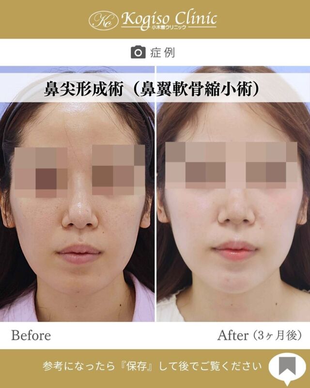 鼻尖形成術（鼻翼軟骨縮小）

鼻先の丸みが改善され、自然に高さのある鼻先に💜

🩺施術内容
鼻柱及び鼻腔内側を切開して鼻尖部の鼻翼軟骨を露出させ、鼻翼軟骨下の鼻腔粘膜との間を慎重に剥離して外側部で軟骨を切離して反転させ、中央で縫縮することで鼻尖部の高さと細さを形成します。

💰施術費用
鼻尖形成術（鼻翼軟骨縮小） ¥500,000 税抜

🔹術後の経過など
固定→1週間テープとアクアプラスト（ギブス）で固定
腫れ→約1週間ほどで落ち着いてきます
抜糸→2週間後に抜糸
傷痕→鼻柱切開の傷痕は3ヶ月ほどで目立たなくなっていきます。術後鼻先が硬くなりますが1ヶ月〜3ヶ月程で徐々に柔らかくなっていきます。

#鼻 #鼻整形 #鼻尖形成 #鼻尖 #鼻尖形成術 #鼻尖縮小 #鼻尖縮小術 #鼻尖整形 #鼻先 #鼻先縮小 #美容整形前後 #美容整形 #小木曽クリニック