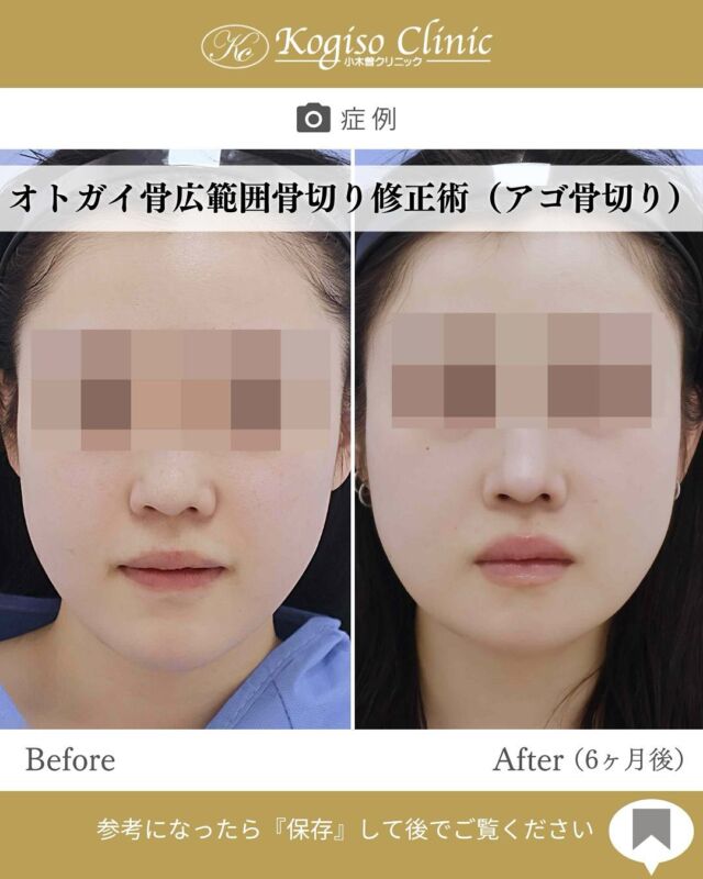オトガイ広範囲骨切り修正術

韓国でVライン形成をされた方で、当院に修正に来られ変化に満足していただけました☺️

【オトガイ広範囲骨切り術】
🩺施術内容
当院のオトガイ広範囲骨切り術はオトガイ神経を剥離し、
オトガイ部から下顎角直前にわたりスムーズなカーブを
描きながら広範囲に骨切りするため、切除量が多く変化が大きいだけでなく自然な仕上がりです。

💰施術費用
オトガイ広範囲骨切り術 ¥1,500,000〜税抜
修正の場合は上記価格に修正費がプラスとなります。
別途全身麻酔•物品•検査代計 ¥233,090

🔹術後の経過など
腫れ→個人差はありますが1週間をピークに2週間ほどで大きな腫れは徐々に引いていきます。
圧迫固定→術後3日間は24時間フェイスバンテージにて圧迫します。
痺れ→オトガイ神経を剥離して手術を行うため、術後しばらく口の周りの感覚が鈍くなります。個人差がありますが6ヶ月程で徐々に回復していきます。
検診→翌日、1ヶ月、6ヶ月
翌日検診の際にドレーンチューブを抜去します。

#輪郭形成 #輪郭整形 #骨切り #アゴ整形 #顎 #下顎前突 #輪郭手術 #骨切り手術 #輪郭整形ビフォーアフター #輪郭整形症例写真 #顔面整形#フェイスライン #美容整形前後 #美容整形 #美容外科 #小木曽クリニック
