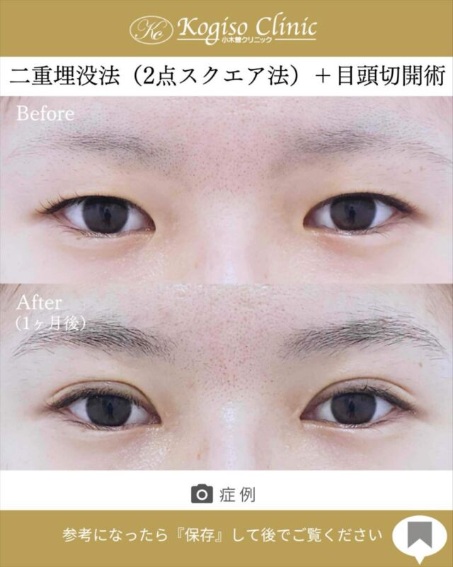 2点スクエアー法+目頭切開術

【2点スクエアー法（二重埋没）】
🩺施術内容
上瞼に開けた小さな穴から細い埋没糸を瞼板と皮膚に
スクエアーにかけて二重のラインを形成します。
腫れがとても少なく自然な二重が可能です。

💰施術費用
2点スクエアー法保証付(二重埋没法) ¥70,000 税抜
2点スクエアー法保証無（二重埋没法）¥50,000 税抜
局所麻酔代、お薬代、検診代込み
保証付は術後１年以内に限りラインが消失してしまった場合左右1回ずつ無料で再手術が受けられます。

🔹術後の経過など
腫れ•違和感→2〜3日をピークに1週間程
内出血→稀に出る場合がございますが1週間程で消失

【目頭切開術】
🩺施術内容
モウコヒダの部分を4mm位のZ型に切開し三角皮弁を入れ替える術です。緊張のかからない自然な方向に皮膚を移動する為モウコヒダをスムーズになくすことができ、腫れが少なく傷跡が残りにくいです。

💰施術費用
目頭切開術 ¥250,000 税抜
局所麻酔代、お薬代、検診代込み

🔹術後の経過など
腫れ→2〜5日をピークに1週間程
内出血→稀に出る場合がございますが1〜2週間程で消失
抜糸→1週間後に抜糸
切開創部→術後は多少赤みがございますが抜糸後はメイクでカバーできる程度で、3ヶ月程でほとんど目立たなくなります。

#目頭切開 #目頭切開法 #目頭切開経過 #二重 #二重整形 #埋没 #二重埋没 #埋没法 #埋没経過 #目の整形
#美容整形前後 #美容整形 #美容外科 #小木曽クリニック