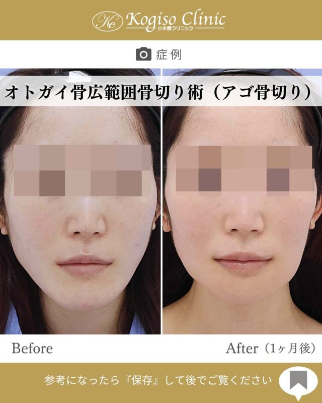オトガイ広範囲骨切り術

アゴが短くなりすっきりした輪郭に🤍
術後1ヶ月であまり違和感がないくらいに落ち着きます💭
当院の術式では切除量が多いため、一時的に皮膚の余りが生じますが術後6ヶ月を目安に徐々に縮んでいき、より骨に馴染んでいきます😌

【オトガイ広範囲骨切り術】
🩺施術内容
当院のオトガイ広範囲骨切り術はオトガイ神経を剥離し、オトガイ部から下顎角直前にわたりスムーズなカーブを描きながら広範囲に骨切りするため、切除量が多く変化が大きいだけでなく自然な仕上がりです。

💰施術費用
オトガイ広範囲骨切り術 ¥1,500,000〜税抜
修正の場合は上記価格に修正費がプラスとなります。
別途全身麻酔•物品•検査代計 ¥233,090

🔹術後の経過など
腫れ→個人差はありますが1週間をピークに2週間ほどで大きな腫れは徐々に引いていきます。
圧迫固定→術後3日間は24時間フェイスバンテージにて圧迫します。
痺れ→オトガイ神経を剥離して手術を行うため、術後しばらく口の周りの感覚が鈍くなります。個人差がありますが6ヶ月程で徐々に回復していきます。
検診→翌日、1ヶ月、6ヶ月
翌日検診の際にドレーンチューブを抜去します。

#輪郭形成 #輪郭整形 #骨切り #アゴ #アゴ骨切り #顎整形 #アゴ整形 #顎 #下顎前突 #輪郭手術 #骨切り手術 #輪郭整形ビフォーアフター #輪郭整形症例写真 #顔面整形#フェイスライン #美容整形前後 #美容整形 #美容外科 #小木曽クリニック
