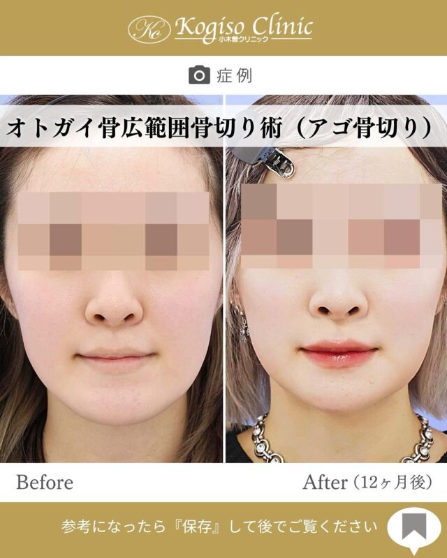 オトガイ広範囲骨切り術

顎が短くなり可愛らしい印象に😊✨

【オトガイ広範囲骨切り術】
🩺施術内容
当院のオトガイ広範囲骨切り術はオトガイ神経を剥離し、
オトガイ部から下顎角直前にわたりスムーズなカーブを
描きながら広範囲に骨切りするため、切除量が多く変化が大きいだけでなく自然な仕上がりです。

💰施術費用
オトガイ広範囲骨切り術 ¥1,500,000〜税抜
修正の場合は上記価格に修正費がプラスとなります。
別途全身麻酔•物品•検査代計 ¥233,090

🔹術後の経過など
腫れ→個人差はありますが1週間をピークに2週間ほどで大きな腫れは徐々に引いていきます
圧迫固定→術後3日間は24時間フェイスバンテージにて圧迫します
痺れ→オトガイ神経を剥離して手術を行うため、術後しばらく口の周りの感覚が鈍くなります。個人差がありますが6ヶ月程で徐々に回復していきます。
検診→翌日、1ヶ月、6ヶ月
翌日検診の際にドレーンチューブを抜去します。

#輪郭形成 #輪郭整形 #骨切り #アゴ整形 #顎 #輪郭手術 
#骨切り手術 #輪郭整形ビフォーアフター #輪郭整形症例写真 #顔面整形#フェイスライン #美容整形前後 #美容整形 #美容外科 #小木曽クリニック