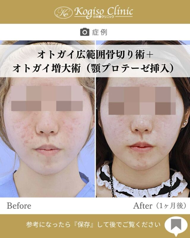 オトガイ広範囲骨切り術+オトガイ増大術(シリコンプロテーゼ挿入)

こちらは術後1ヶ月のお写真です😳🌟
既に大きな腫れは落ち着き、完成形に近づいていますが、今後半年程かけて浮腫みや硬さが取れより自然になってきます😌

また、オトガイ増大術は顎の後退が気になる方にオススメのご手術です！
横顔やフェイスラインの変化が出やすく、効果を実感しやすいご手術です🙌

【オトガイ広範囲骨切り術】
🩺施術内容
当院のオトガイ広範囲骨切り術はオトガイ神経を剥離し、
オトガイ部から下顎角直前にわたりスムーズなカーブを
描きながら広範囲に骨切りするため、切除量が多く変化が大きいだけでなく自然な仕上がりです。

💰施術費用
オトガイ広範囲骨切り術 ¥1,500,000〜税抜
修正の場合は上記価格に修正費がプラスとなります。
別途全身麻酔•物品•検査代計 ¥233,090

🔹術後の経過など
腫れ→個人差はありますが1週間をピークに2週間ほどで大きな腫れは徐々に引いていきます。
圧迫固定→術後3日間は24時間フェイスバンテージにて圧迫します。
痺れ→オトガイ神経を剥離して手術を行うため、術後しばらく口の周りの感覚が鈍くなります。個人差がありますが6ヶ月程で徐々に回復していきます。
検診→翌日、1ヶ月、6ヶ月
翌日検診の際にドレーンチューブを抜去します。

【オトガイ増大術(顎プロテーゼ挿入)】
🩺施術内容
口腔内を切開し、骨膜下を剥離してシリコンプロテーゼを
挿入します。
💰施術費用
顎プロテーゼ挿入術 ¥300,000 税抜
局所麻酔代、お薬代、検診代込み
チタンスクリュー固定される場合　¥500,000 税抜
チタンスクリュー固定は全身麻酔で行う為別途麻酔代、全身麻酔に必要な術前検査代が必要となります。
入替の場合は費用が変動します。

#輪郭 #骨切り#ビフォーアフター #顎プロテーゼ #小木曽クリニック