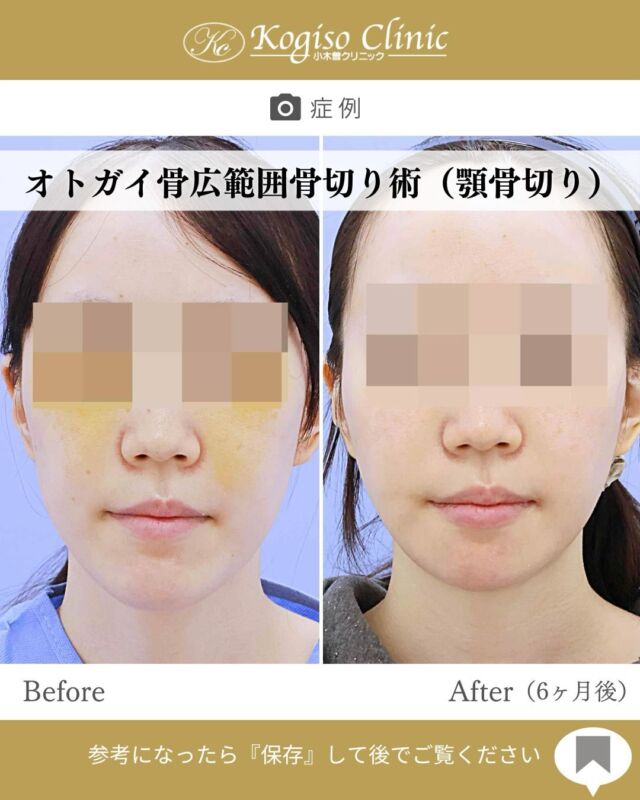 オトガイ広範囲骨切り修正術

保険適用でのご手術を受けられた後の修正術です😊✨
当院では修正のご相談も多く承っております👨🏻‍⚕️

【オトガイ広範囲骨切り術】
🩺施術内容
当院のオトガイ広範囲骨切り術はオトガイ神経を剥離し、
オトガイ部から下顎角直前にわたりスムーズなカーブを
描きながら広範囲に骨切りするため、切除量が多く変化が大きいだけでなく自然な仕上がりです。

💰施術費用
オトガイ広範囲骨切り術 ¥1,500,000〜税抜
修正の場合は上記価格に修正費がプラスとなります。
別途全身麻酔•物品•検査代計 ¥233,090

🔹術後の経過など
腫れ→個人差はありますが1週間をピークに2週間ほどで大きな腫れは徐々に引いていきます
圧迫固定→術後3日間は24時間フェイスバンテージにて圧迫します
痺れ→オトガイ神経を剥離して手術を行うため、術後しばらく口の周りの感覚が鈍くなります。個人差がありますが6ヶ月程で徐々に回復していきます。
検診→翌日、1ヶ月、6ヶ月
翌日検診の際にドレーンチューブを抜去します。