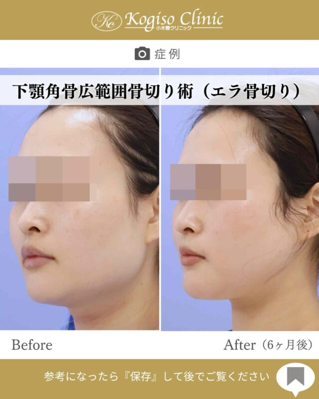 下顎角広範囲骨切り術

エラのご手術は正面顔も横顔も変化が大きく、ご満足いただける患者様が多いです😊
当院の術式は口腔外からのアプローチで、一般的な口腔内からのご手術より安全性が高く、骨切り量も多くなります👨🏻‍⚕️💪

【下顎角広範囲骨切り術】
🩺施術内容
下顎角部の皮膚を2〜3㎝切開、骨膜下を広範囲に剥離し
オトガイ部から下顎角上方の顎関節付近までを広範囲に骨切りし、盛り上がった隆起部の外板を削るため横顔だけでなく正面顔も変化を得られます。骨切りラインは滑らかなカーブを描いているので術後のエラのラインは自然です。

💰施術費用
下顎角広範囲骨切り術 ¥1,500,000 税抜
修正の場合は上記価格に修正費がプラスとなります。
別途全身麻酔•物品•検査代計¥233,090

🔹術後の経過など
腫れ→個人差はございますが1週間をピークに2週間ほどで大きな腫れは徐々に落ち着いてきます。
圧迫固定→術後3日間は24時間フェイスバンテージにて圧迫し腫れを予防します。
検診→翌日、1ヶ月、6ヶ月　翌日検診にてドレーン抜去します。
傷痕→切開ラインは経過とともに徐々に目立たなくなっていき、個人差ございますが3〜6ヶ月で細いシワのようになります。

#輪郭 #輪郭整形 #輪郭形成 #輪郭手術 #骨切り