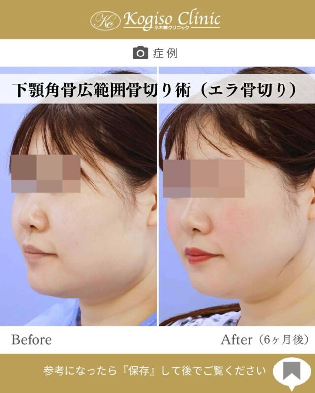 下顎角広範囲骨切り術後6ヶ月のお写真です❕💁🏻‍♀️💭🌟
エラの張りを改善し、フェイスラインをスッキリとした印象へ😌✨
骨格に合わせてデザインを行い、正面・斜め・横顔までバランスの整った輪郭を目指します👨🏻‍⚕️

【下顎角広範囲骨切り術】
🩺施術内容
下顎角部の皮膚を2〜3㎝切開、骨膜下を広範囲に剥離し
オトガイ部から下顎角上方の顎関節付近までを広範囲に骨切りし、盛り上がった隆起部の外板を削るため横顔だけでなく正面顔も変化を得られます。骨切りラインは滑らかなカーブを描いているので術後のエラのラインは自然です。

💰施術費用
下顎角広範囲骨切り術 ¥1,500,000 税抜
修正の場合は上記価格に修正費がプラスとなります。
別途全身麻酔•物品•検査代計¥233,090

🔹術後の経過など
腫れ→個人差はございますが1週間をピークに2週間ほどで大きな腫れは徐々に落ち着いてきます。
圧迫固定→術後3日間は24時間フェイスバンテージにて圧迫し腫れを予防します。
検診→翌日、1ヶ月、6ヶ月　翌日検診にてドレーン抜去します。
傷痕→切開ラインは経過とともに徐々に目立たなくなっていき、個人差ございますが3〜6ヶ月で細いシワのようになります。

#輪郭 #輪郭整形 #輪郭形成 #輪郭手術 #骨切り