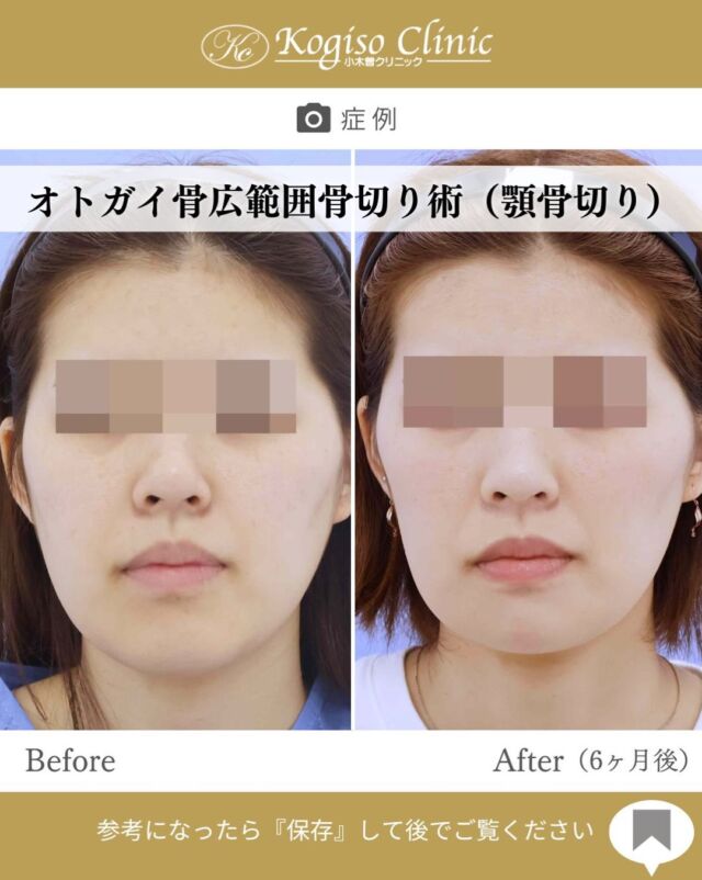 お顔全体のバランスを見ながら、オトガイの形・長さを整えました💭✨
オトガイのラインを整えることで、横顔だけでなく正面から見た際のお顔の印象もスッキリとした印象に❕💁🏻‍♀️🌟
1人1人異なる骨格や輪郭に合わせてデザインし、自然なフェイスラインを目指します💆🏻‍♀️💞✨

【オトガイ広範囲骨切り術】
🩺施術内容
当院のオトガイ広範囲骨切り術はオトガイ神経を剥離し、
オトガイ部から下顎角直前にわたりスムーズなカーブを
描きながら広範囲に骨切りするため、切除量が多く変化が大きいだけでなく自然な仕上がりです。

💰施術費用
オトガイ広範囲骨切り術 ¥1,500,000〜税抜
修正の場合は上記価格に修正費がプラスとなります。
別途全身麻酔•物品•検査代計 ¥233,090

🔹術後の経過など
腫れ→個人差はありますが1週間をピークに2週間ほどで大きな腫れは徐々に引いていきます
圧迫固定→術後3日間は24時間フェイスバンテージにて圧迫します
痺れ→オトガイ神経を剥離して手術を行うため、術後しばらく口の周りの感覚が鈍くなります。個人差がありますが6ヶ月程で徐々に回復していきます。
検診→翌日、1ヶ月、6ヶ月
翌日検診の際にドレーンチューブを抜去します。

#輪郭形成 #美容外科 #整形ビフォーアフター #小木曽クリニック